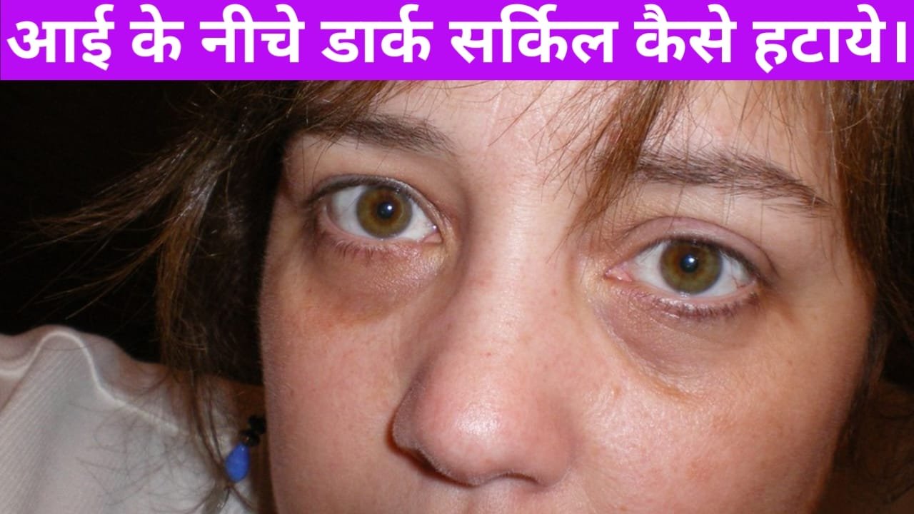 Eye ke niche dark circles kaise hataye