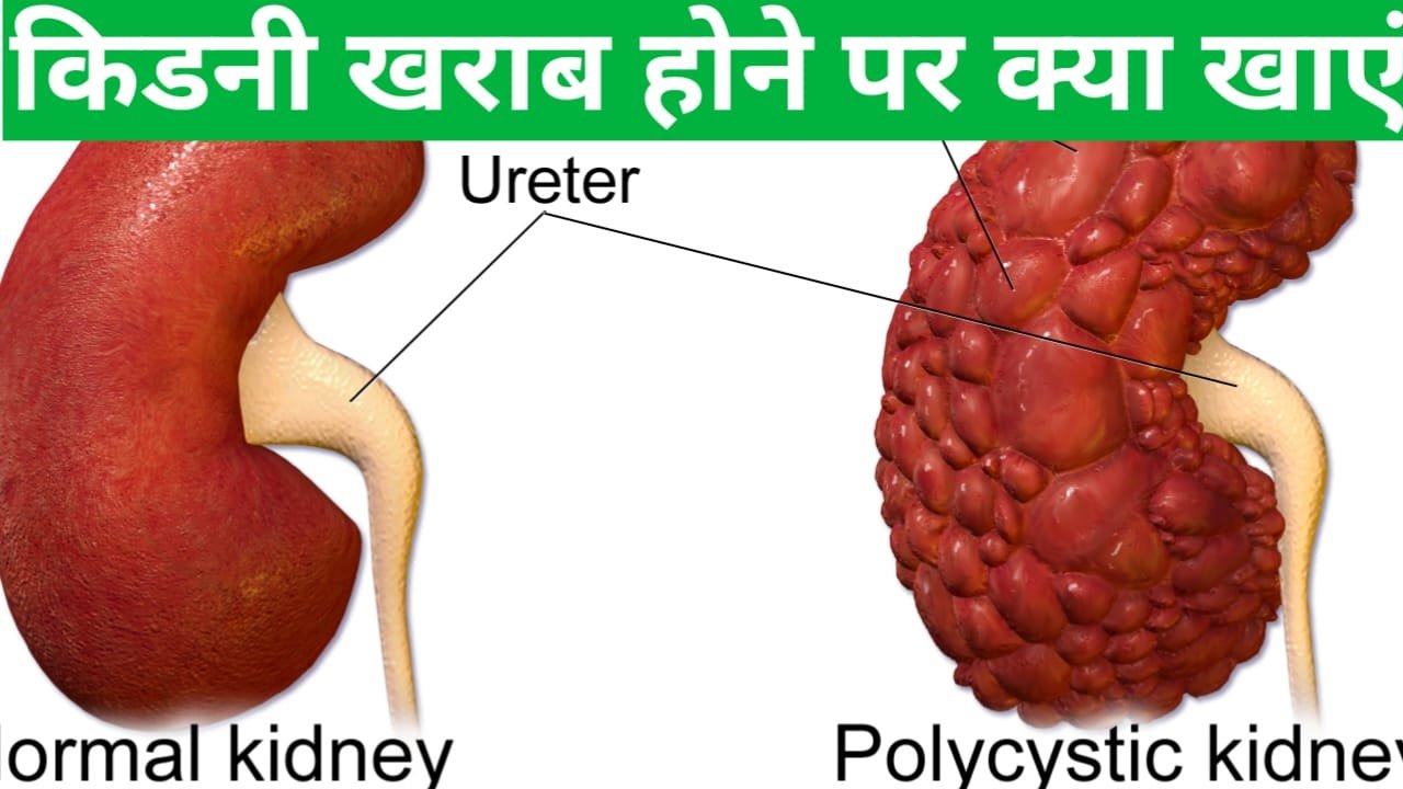 Kidney kharab hone par kya khaye